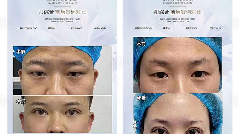 小标题：哺乳期，美容注射的隐忧