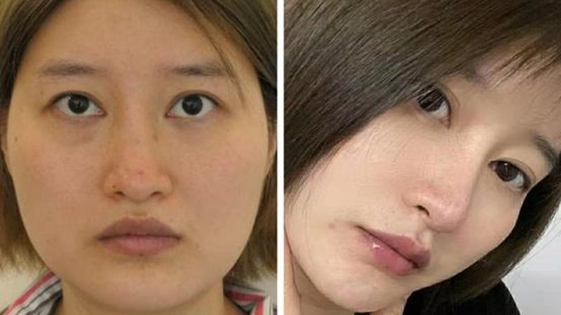 如何辨别热玛吉真伪？揭秘四大鉴别技巧