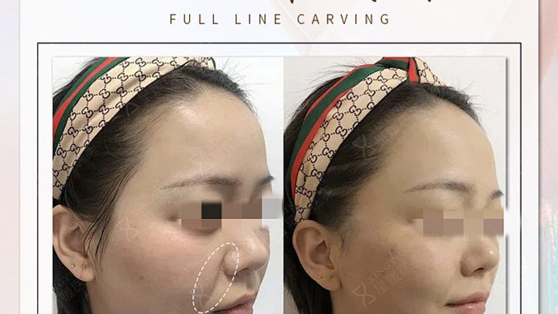 水光针，如何挑选最适合你的那一款？**