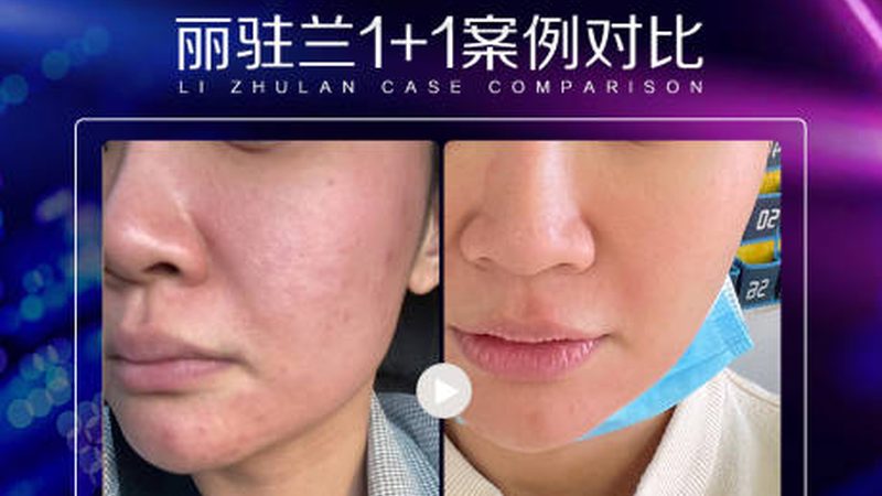 定制激光脱毛机，尺寸与材质背后的奥秘