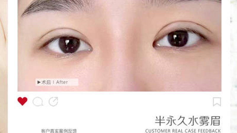 女生私处激光脱毛，疼痛体验揭秘