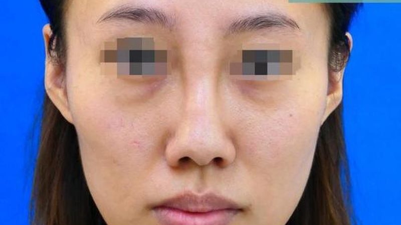 肉毒素注射效果显现，揭秘最佳时间点